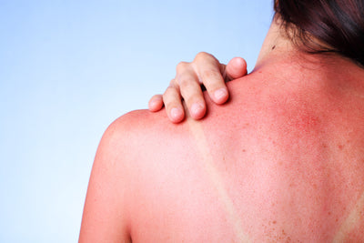 Protection solaire intelligente : comment prévenir les dommages causés par le soleil sur la poitrine